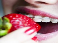 Diş Teli İle İlgili 5 Önemli Bilgi